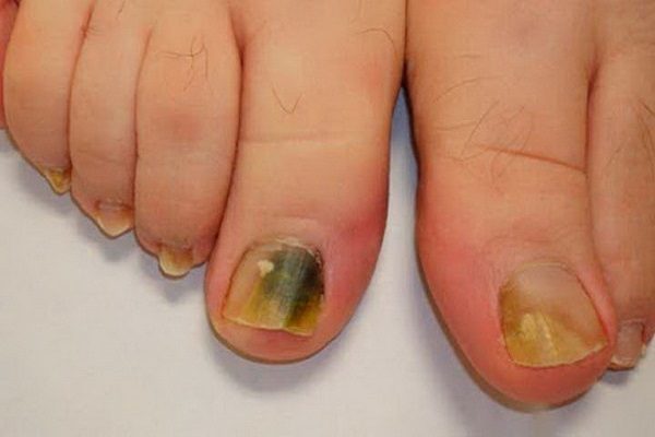 3-ingredients-eliminate-toenail-fungus-600x400-1