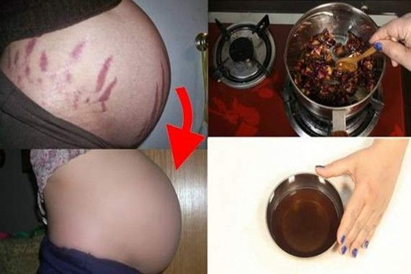 miracle-oil-will-remove-scars-spots-stretch-marks-skin-3-days