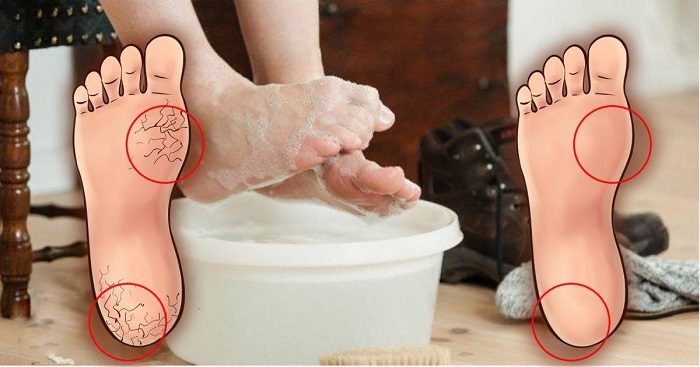 soak-feet-powerful-baking-soda-mixture-2x-week-heal-dry-cracked-feet