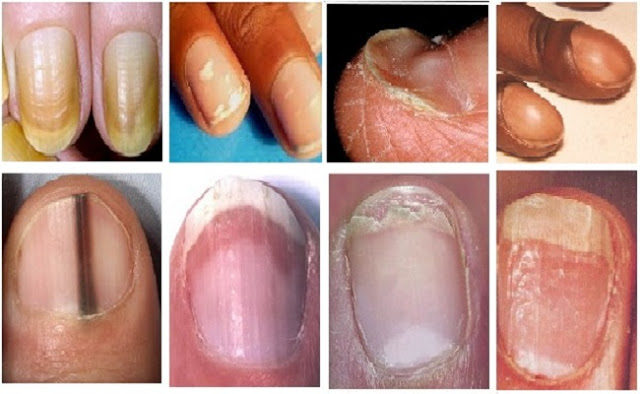 what-fingernail-abnormalities-say-about-your-health