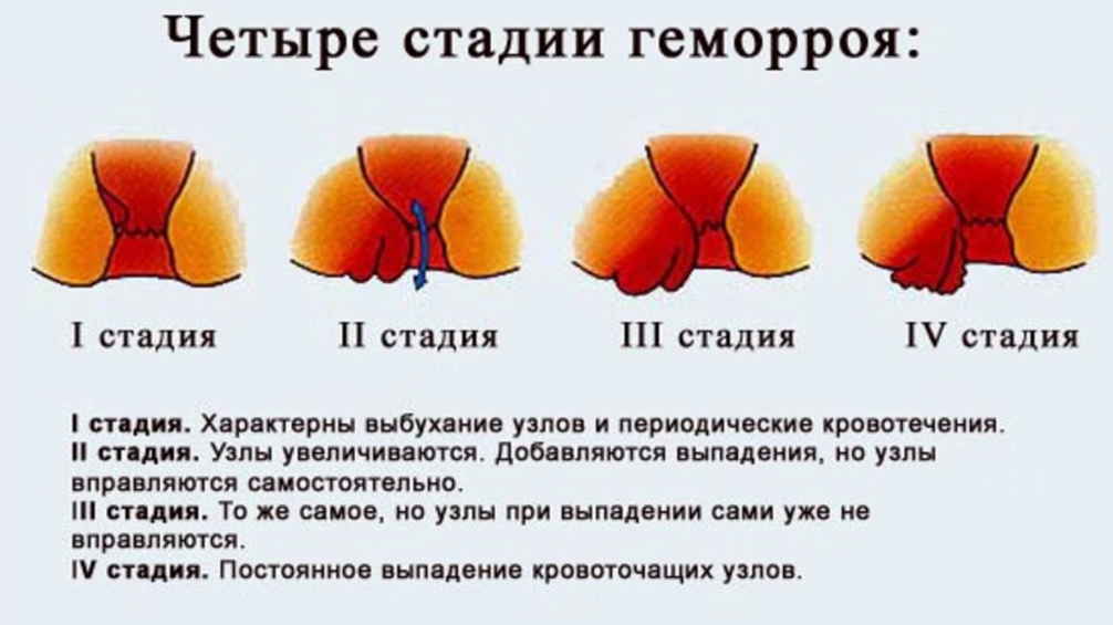 Лечение геморроя — рецепты мы не скроем. Очень средства ценные, в лечении отменные!