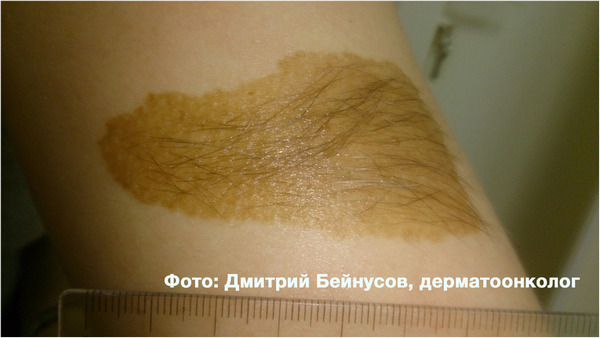 Опасные родинки: 3 правила для предупреждения меланомы