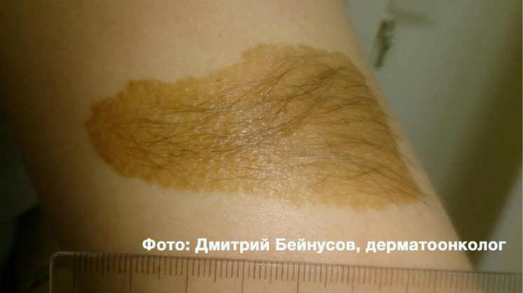 Меланома — самая опасная разновидность рака кожи. Можно ли удалять родинки? И как понять, что родинка безопасна?